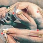 fibromialgia
