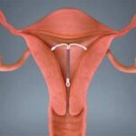 El dispositivo intrauterino o DIU y el bloqueo de la energía
